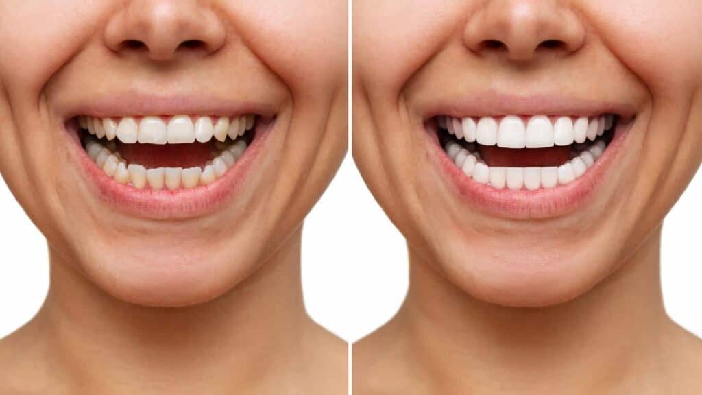 Contact Aspire White for teeth whitening services – Get in touch with Enfield Town today