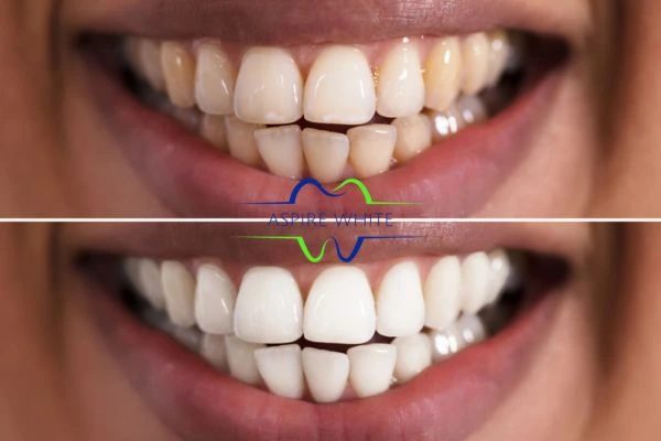 Aspire White customer before and after Enfield Town results.