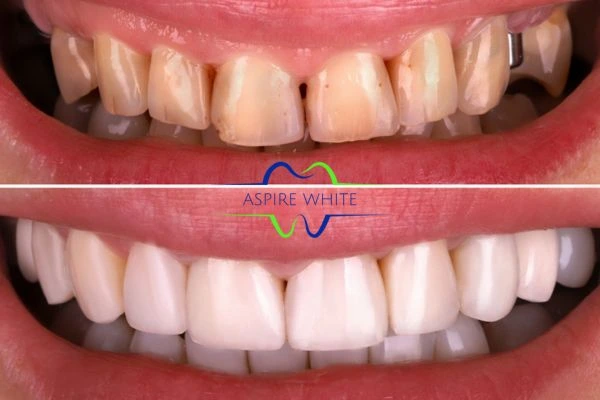 Before And After Results Enfield Town