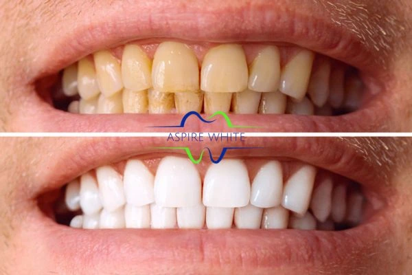 Get noticeable whiter smile in just one hour! Book your teeth whitening treatment Enfield Town today!