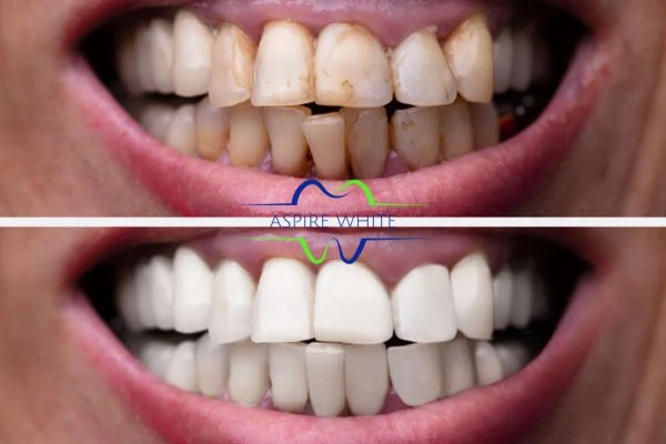 Before and after results of laser teeth whitening Enfield Town Book in online today!