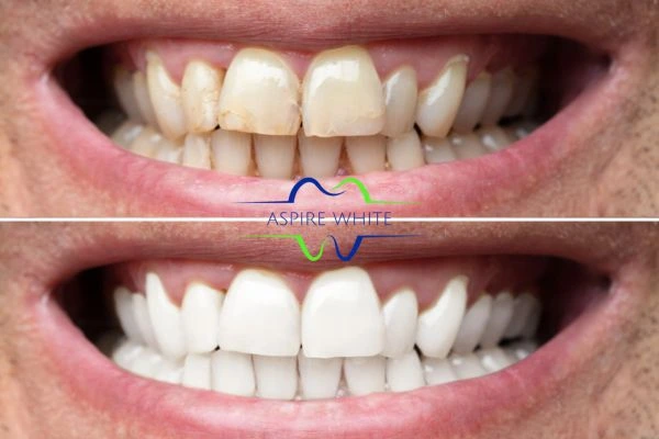 Achieve a radiant smile with professional laser teeth whitening Enfield Town